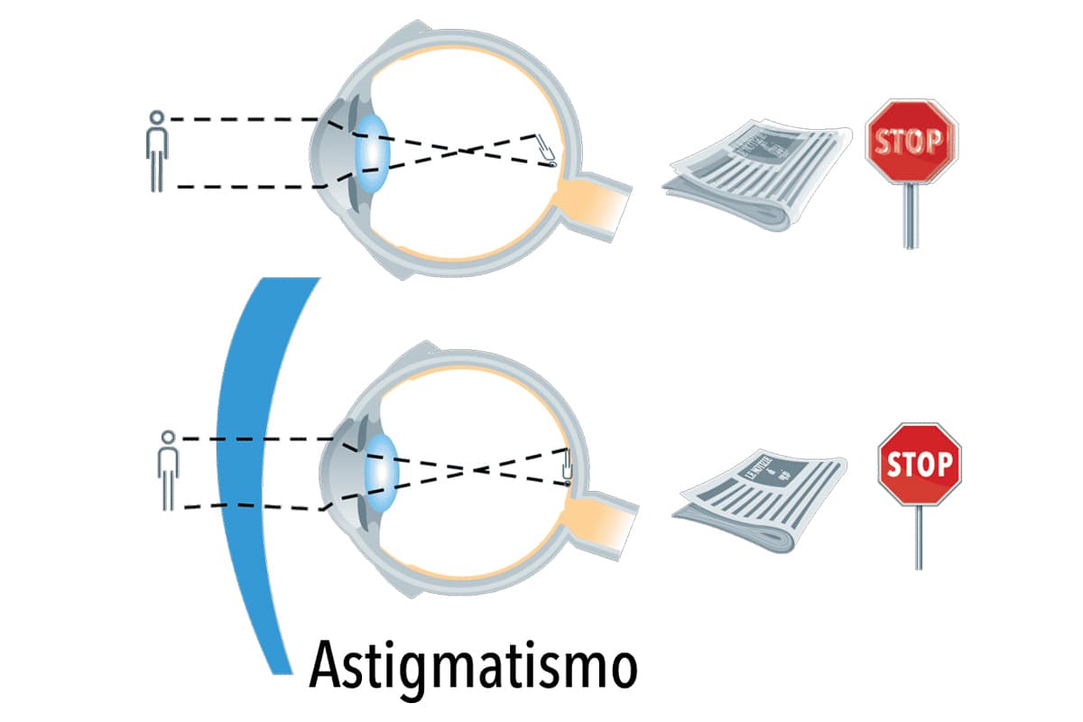 Lenti per astigmatismo: visione nitida e senza distorsioni